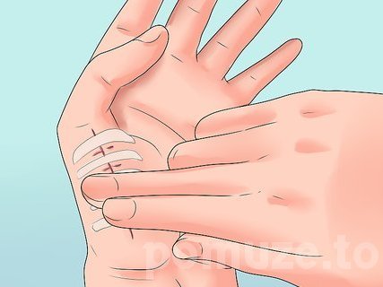 Steri-Strip – náplasťové stehy